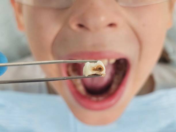 Best Emergency Dental Care for Broken or Chipped Teeth in Park Ridge, NJ